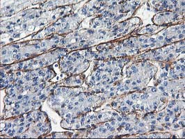 ARH / LDLRAP1 Antibody - IHC of paraffin-embedded Carcinoma of Human liver tissue using anti-LDLRAP1 mouse monoclonal antibody.