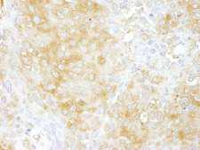 ARHGAP1 / CDC42GAP Antibody - Detection of Human Cdc42GAP by Immunohistochemistry. Sample: FFPE section of human breast carcinoma. Antibody: Affinity purified rabbit anti-Cdc42GAP used at a dilution of 1:100.