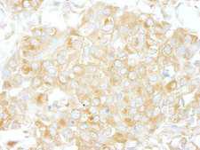 ARHGAP1 / CDC42GAP Antibody - Detection of Human Cdc42GAP by Immunohistochemistry. Sample: FFPE section of human breast carcinoma. Antibody: Affinity purified rabbit anti-Cdc42GAP used at a dilution of 1:200 (1 ug/ml).