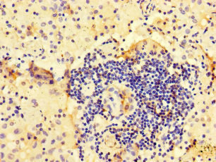 ARHGAP10 Antibody - Immunohistochemistry of paraffin-embedded human lung cancer at dilution of 1:100