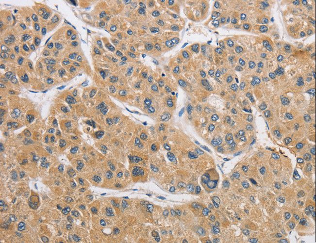 ARHGAP15 Antibody - Immunohistochemistry of paraffin-embedded Human liver cancer using ARHGAP15 Polyclonal Antibody at dilution of 1:50.