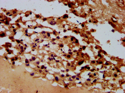 ARHGAP15 Antibody - Immunohistochemistry Dilution at 1:600 and staining in paraffin-embedded human melanoma cancer performed on a Leica BondTM system. After dewaxing and hydration, antigen retrieval was mediated by high pressure in a citrate buffer (pH 6.0). Section was blocked with 10% normal Goat serum 30min at RT. Then primary antibody (1% BSA) was incubated at 4°C overnight. The primary is detected by a biotinylated Secondary antibody and visualized using an HRP conjugated SP system.