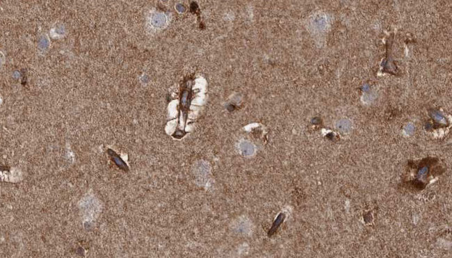 ARHGAP20 Antibody - 1:100 staining human brain carcinoma tissue by IHC-P. The sample was formaldehyde fixed and a heat mediated antigen retrieval step in citrate buffer was performed. The sample was then blocked and incubated with the antibody for 1.5 hours at 22°C. An HRP conjugated goat anti-rabbit antibody was used as the secondary.