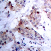 ARHGAP23 Antibody - Immunohistochemical analysis of ARHGAP23 staining in human breast cancer formalin fixed paraffin embedded tissue section. The section was pre-treated using heat mediated antigen retrieval with sodium citrate buffer (pH 6.0). The section was then incubated with the antibody at room temperature and detected using an HRP polymer system. DAB was used as the chromogen. The section was then counterstained with hematoxylin and mounted with DPX.