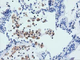 ARHGAP25 Antibody - IHC of paraffin-embedded Carcinoma of Human lung tissue using anti-ARHGAP25 mouse monoclonal antibody. (Dilution 1:50).