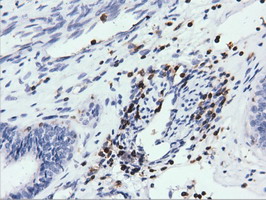 ARHGAP25 Antibody - Immunohistochemical staining of paraffin-embedded Adenocarcinoma of Human endometrium tissue using anti-ARHGAP25 mouse monoclonal antibody. (Dilution 1:50).