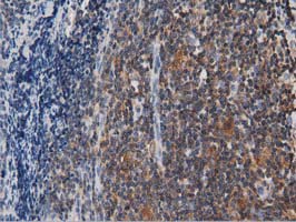 ARHGAP25 Antibody - IHC of paraffin-embedded Human lymphoma tissue using anti-ARHGAP25 mouse monoclonal antibody. (Dilution 1:50).