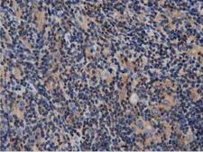 ARHGAP25 Antibody - IHC of paraffin-embedded Human lymphoma tissue using anti-ARHGAP25 mouse monoclonal antibody. (Dilution 1:50).