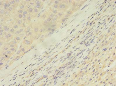 ARHGAP25 Antibody - Immunohistochemistry of paraffin-embedded human liver cancer using antibody at dilution of 1:100.