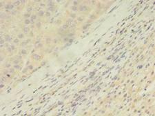 ARHGAP25 Antibody - Immunohistochemistry of paraffin-embedded human liver cancer using antibody at dilution of 1:100.