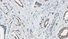 ARHGAP25 Antibody - 1:100 staining human prostate tissue by IHC-P. The sample was formaldehyde fixed and a heat mediated antigen retrieval step in citrate buffer was performed. The sample was then blocked and incubated with the antibody for 1.5 hours at 22°C. An HRP conjugated goat anti-rabbit antibody was used as the secondary.