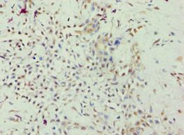 ARHGAP26 / GRAF Antibody - Immunohistochemistry of paraffin-embedded human breast cancer using antibody at 1:100 dilution.