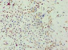 ARHGAP26 / GRAF Antibody - Immunohistochemistry of paraffin-embedded human breast cancer using antibody at 1:100 dilution.
