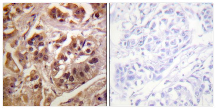 ARHGAP35 / GRLF1 Antibody - Peptide - + Immunohistochemistry analysis of paraffin-embedded human breast carcinoma tissue using GRF-1 antibody.
