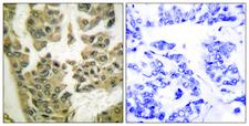 ARHGAP35 / GRLF1 Antibody - Immunohistochemistry analysis of paraffin-embedded human breast carcinoma, using GRF-1 (Phospho-Tyr1105) Antibody. The picture on the right is blocked with the phospho peptide.