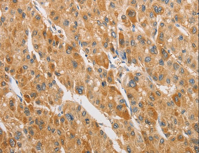 ARHGAP5 / RhoGAP5 Antibody - Immunohistochemistry of paraffin-embedded Human liver cancer using ARHGAP5 Polyclonal Antibody at dilution of 1:30.