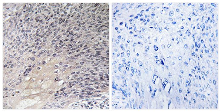 ARHGDIA / RHOGDI Antibody - Peptide - + Immunohistochemistry analysis of paraffin-embedded human cervix carcinoma tissue using ARHGDIA antibody.
