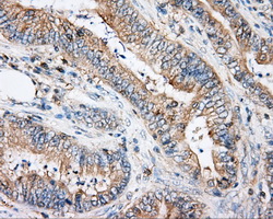 ARHGDIA / RHOGDI Antibody - IHC of paraffin-embedded Adenocarcinoma of colon tissue using anti-ARHGDIA mouse monoclonal antibody. (Dilution 1:50).