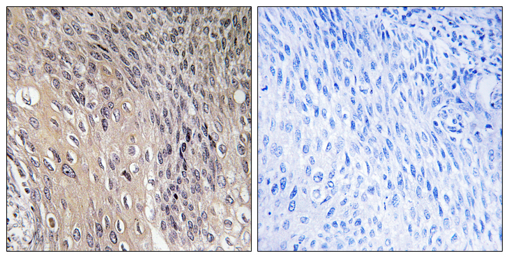 ARHGDIA / RHOGDI Antibody - Immunohistochemistry analysis of paraffin-embedded human cervix carcinoma, using ARHGDIA (Phospho-Ser174) Antibody. The picture on the right is blocked with the phospho peptide.