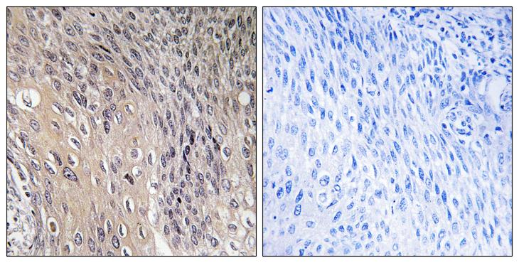 ARHGDIA / RHOGDI Antibody - P-peptide - + Immunohistochemistry analysis of paraffin-embedded human cervix carcinoma tissue using ARHGDIA (Phospho-Ser174) antibody.