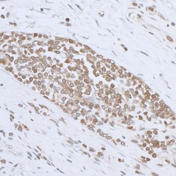 ARHGDIB / D4 GDI Antibody - Detection of human ARHGDIB/D4-GDI by immunohistochemistry. Sample: FFPE section of human stomach carcinoma inflammatory cell infiltrate. Antibody: Affinity purified rabbit anti- ARHGDIB/D4-GDI used at a dilution of 1:1,000 (1µg/ml). Detection: DAB