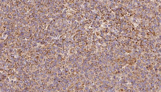 ARHGDIB / D4 GDI Antibody - 1:100 staining human lymph carcinoma tissue by IHC-P. The sample was formaldehyde fixed and a heat mediated antigen retrieval step in citrate buffer was performed. The sample was then blocked and incubated with the antibody for 1.5 hours at 22°C. An HRP conjugated goat anti-rabbit antibody was used as the secondary.