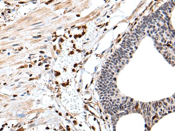 ARHGDIB / D4 GDI Antibody - Immunohistochemistry of paraffin-embedded Human gastric cancer tissue  using ARHGDIB Polyclonal Antibody at dilution of 1:35(×200)
