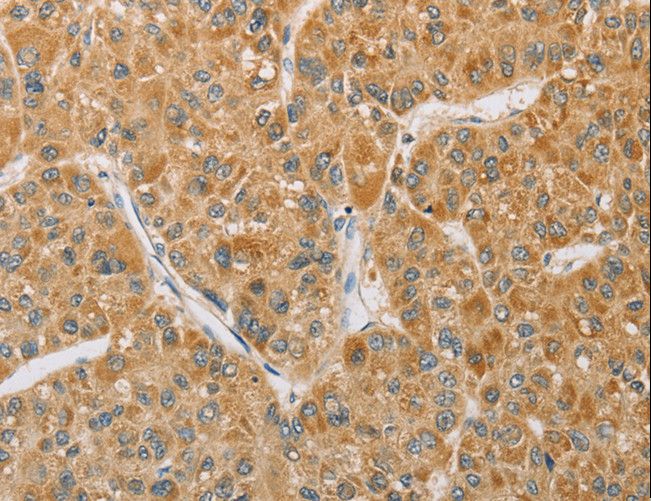 ARHGEF1 Antibody - Immunohistochemistry of paraffin-embedded Human liver cancer using ARHGEF1 Polyclonal Antibody at dilution of 1:60.
