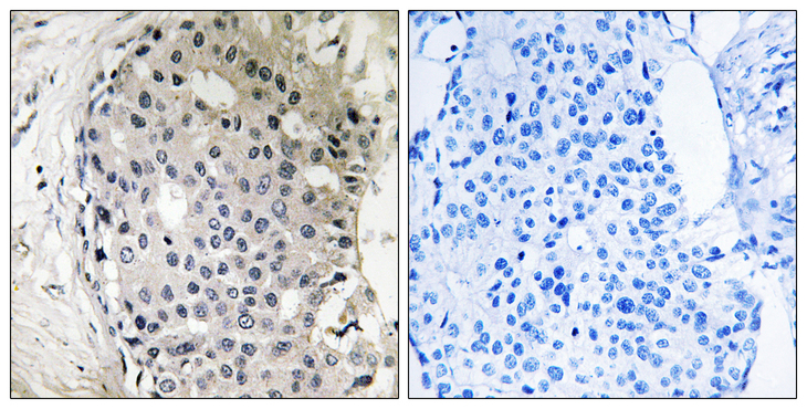 ARHGEF10 / GEF10 Antibody - Immunohistochemistry analysis of paraffin-embedded human breast carcinoma tissue, using ARHGEF10 Antibody. The picture on the right is blocked with the synthesized peptide.