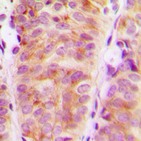 ARHGEF10 / GEF10 Antibody - Immunohistochemical analysis of ARHGEF10 staining in human breast cancer formalin fixed paraffin embedded tissue section. The section was pre-treated using heat mediated antigen retrieval with sodium citrate buffer (pH 6.0). The section was then incubated with the antibody at room temperature and detected using an HRP conjugated compact polymer system. DAB was used as the chromogen. The section was then counterstained with hematoxylin and mounted with DPX.