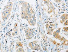 ARHGEF10 / GEF10 Antibody - Immunohistochemistry of paraffin-embedded Human cervical cancer using ARHGEF10 Polyclonal Antibody at dilution of 1:45.