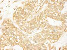 ARHGEF11 Antibody - Detection of Human PDZ-RhoGEF by Immunohistochemistry. Sample: FFPE section of human breast carcinoma. Antibody: Affinity purified rabbit anti-PDZ-RhoGEF used at a dilution of 1:1000 (1 ug/ml). Detection: DAB.