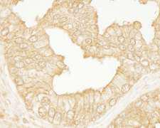 ARHGEF11 Antibody - Detection of Human PDZ-RhoGEF by Immunohistochemistry. Sample: FFPE section of human prostate carcinoma. Antibody: Affinity purified rabbit anti-PDZ-RhoGEF used at a dilution of 1:100.