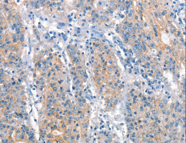 ARHGEF11 Antibody - Immunohistochemistry of paraffin-embedded Human gastric cancer using ARHGEF11 Polyclonal Antibody at dilution of 1:25.