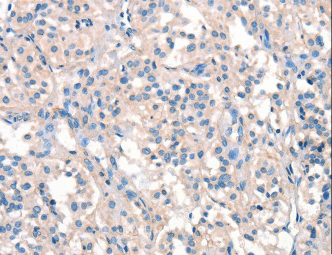 ARHGEF11 Antibody - Immunohistochemistry of paraffin-embedded Human thyroid cancer using ARHGEF11 Polyclonal Antibody at dilution of 1:25.