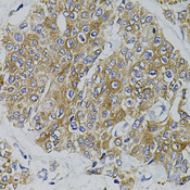 ARHGEF11 Antibody - Immunohistochemistry of paraffin-embedded human prostate cancer tissue.