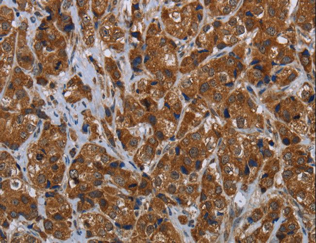 ARHGEF12 Antibody - Immunohistochemistry of paraffin-embedded Human breast cancer using ARHGEF12 Polyclonal Antibody at dilution of 1:30.