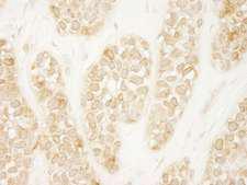 ARHGEF16 Antibody - Detection of Human ARHGEF16 by Immunohistochemistry. Sample: FFPE section of human breast carcinoma. Antibody: Affinity purified rabbit anti-ARHGEF16 used at a dilution of 1:250.
