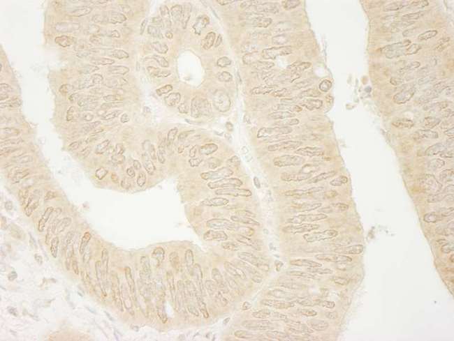 ARHGEF16 Antibody - Detection of Human ARHGEF16 by Immunohistochemistry. Sample: FFPE section of human colon carcinoma. Antibody: Affinity purified rabbit anti-ARHGEF16 used at a dilution of 1:250. Epitope Retrieval Buffer-High pH (IHC-101J) was substituted for Epitope Retrieval Buffer-Reduced pH.