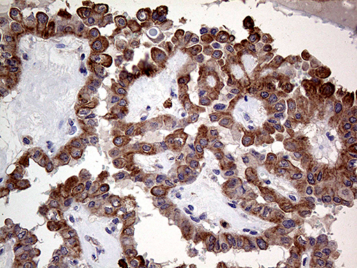 ARHGEF18 Antibody - Immunohistochemical staining of paraffin-embedded Carcinoma of Human thyroid tissue using anti-ARHGEF18 mouse monoclonal antibody. (Heat-induced epitope retrieval by 1mM EDTA in 10mM Tris buffer. (pH8.5) at 120°C for 3 min. (1:500)