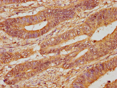 ARHGEF18 Antibody - IHC image of ARHGEF18 Antibody diluted at 1:200 and staining in paraffin-embedded human colon cancer performed on a Leica BondTM system. After dewaxing and hydration, antigen retrieval was mediated by high pressure in a citrate buffer (pH 6.0). Section was blocked with 10% normal goat serum 30min at RT. Then primary antibody (1% BSA) was incubated at 4°C overnight. The primary is detected by a biotinylated secondary antibody and visualized using an HRP conjugated SP system.