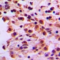 ARHGEF19 / WGEF Antibody - Immunohistochemical analysis of ARHGEF19 staining in human lung cancer formalin fixed paraffin embedded tissue section. The section was pre-treated using heat mediated antigen retrieval with sodium citrate buffer (pH 6.0). The section was then incubated with the antibody at room temperature and detected using an HRP conjugated compact polymer system. DAB was used as the chromogen. The section was then counterstained with haematoxylin and mounted with DPX.
