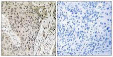 ARHGEF19 / WGEF Antibody - Peptide - + Immunohistochemistry analysis of paraffin-embedded human lung carcinoma tissue using ARHGEF19 antibody.