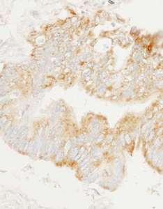 ARHGEF2 / GEF-H1 Antibody - Detection of Human GEF-H1 by Immunohistochemistry. Sample: FFPE section of human lung carcinoma. Antibody: Affinity purified rabbit anti-GEF-H1 used at a dilution of 1:1000 (1 Detection: DAB.
