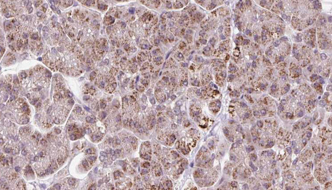 ARHGEF25 / GEFT Antibody - 1:100 staining human pancreas carcinoma tissue by IHC-P. The sample was formaldehyde fixed and a heat mediated antigen retrieval step in citrate buffer was performed. The sample was then blocked and incubated with the antibody for 1.5 hours at 22°C. An HRP conjugated goat anti-rabbit antibody was used as the secondary.