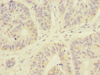 ARHGEF3 / XPLN Antibody - Immunohistochemistry of paraffin-embedded human colon cancer at dilution 1:100