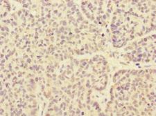 ARHGEF3 / XPLN Antibody - Immunohistochemistry of paraffin-embedded human ovarian cancer at dilution 1:100