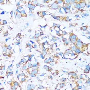 ARHGEF5 Antibody - Immunohistochemistry of paraffin-embedded Human breast cancer using ARHGEF5 Polyclonal Antibody at dilution of 1:100 (40x lens).