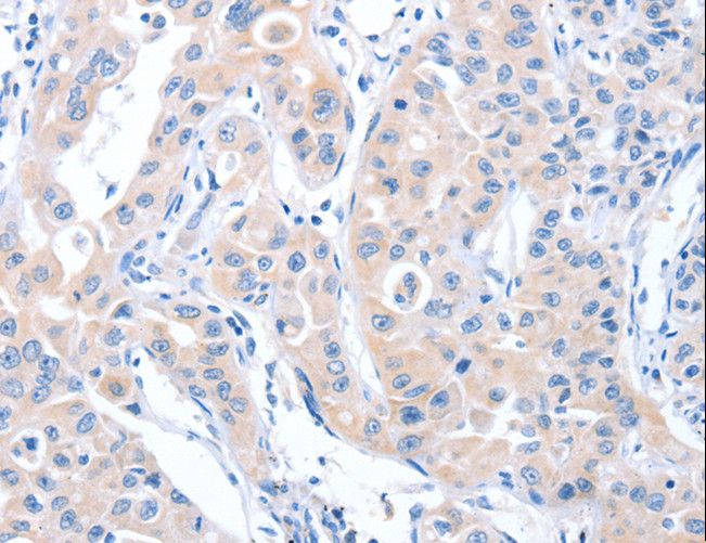 ARHGEF6 Antibody - Immunohistochemistry of paraffin-embedded Human lung cancer using ARHGEF6 Polyclonal Antibody at dilution of 1:70.