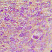 ARHGEF7 Antibody - Immunohistochemical analysis of ARHGEF7 staining in human breast cancer formalin fixed paraffin embedded tissue section. The section was pre-treated using heat mediated antigen retrieval with sodium citrate buffer (pH 6.0). The section was then incubated with the antibody at room temperature and detected using an HRP conjugated compact polymer system. DAB was used as the chromogen. The section was then counterstained with hematoxylin and mounted with DPX.